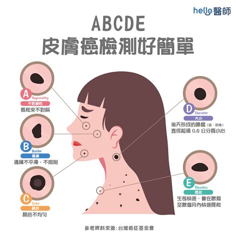 臉上長黑毛原因|痣形成的原因？痣長毛、痣變多變大是痣病變？5招判別